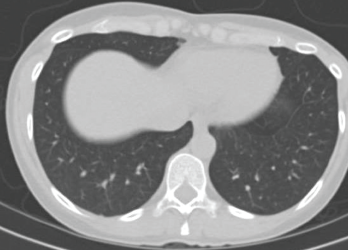 A CT scan taken four weeks after treatment was initiated with high-dose prednisone shows complete resolution of the infiltrates.