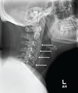Cervical spine radiograph, lateral view, demonstrating flowing anterior ossifications (white arrows) bridging four consecutive vertebrae (C2–C3 through C5–C6), but with relative preservation of the disc space.