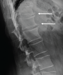 Lumbar spine radiograph, lateral view, demonstrating anterior endplate osteophytes at the levels of T12–L1 and L1–L2 (white arrows). 