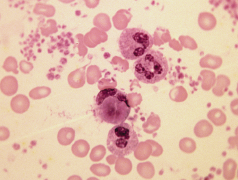 Blood smear in lupus erythematosus.