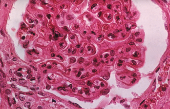 The pattern of lupus glomerular involvement is similar to that in membranous nephropathy, forming wire-loop lesions. 