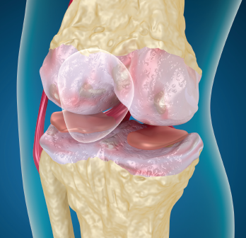 Osteoarthritis of the knee