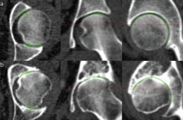 JSM performance at the extremes of disease. Joint space margins are shown in green as seen in axial, coronal and sagittal planes (left to right) at two left hips. (a) An individual with a radiographic K&L grade of 0 (no disease) and minimum joint space width of 2.0 mm. (b) An individual with a radiographic K&L grade of 3 (moderate disease) and minimum joint space width of 0 mm. This demonstrates that JSM is still able to represent joint space width as it approaches zero, important for analysis in advanced disease. Credit: Reprinted by permission from “A new quantitative 3D approach to imaging of structural joint disease,” Scientific Reports, under the Creative Commons Attribution 4.0 International (CC BY) license (https://creativecommons.org/licenses/by/4.0/legalcode).