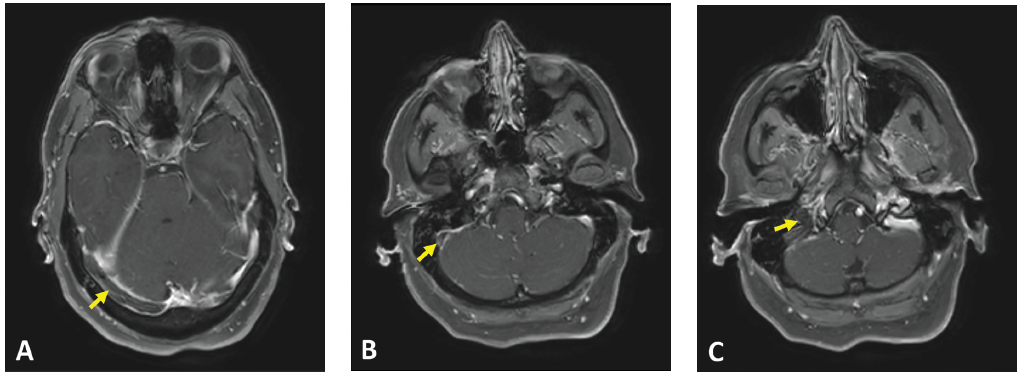 Figure 1: Axial T1 contrast MR image showing non-enhancement within the (A) right transverse sinus, (B) right sigmoid sinus and (C) right internal jugular vein. Associated dural enhancement is visualized around the transverse sinus (A) and sigmoid sinus (B).