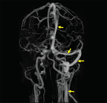 Figure 2: A contrast-enhanced MRV shows a filling defect in the right internal jugular vein, right sigmoid sinus, right transverse sinus and superior sagittal sinus. Normal enhancement of the respective structures is visualized on the left side (arrow).