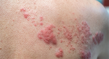 This rash shows the effects of varicella-zoster reactivation—shingles.