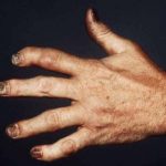 psoriatic arthritis hand photo