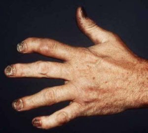 psoriatic arthritis hand photo