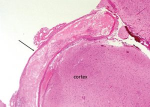 The leptomenigeal artery has significant narrowing due to cholesterol accumulation, and intramural and perivascular inflammatory infiltrates.