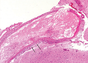 The image at higher magnification is highlighted to show the cholesterol accumulation, and intramural and perivascular inflammatory infiltrates.