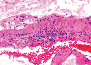 The image at even higher magnification shows the cholesterol accumulation, and intramural and perivascular inflammatory infiltrates.