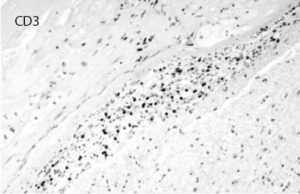 Figure 8: Immunostaining for CD3 highlights the inflammatory T cell population permeating the vascular wall. CD20 was mostly negative.