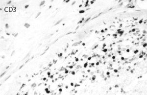 Figure 8: Immunostaining for CD3 highlights the inflammatory T cell population permeating the vascular wall. CD20 was mostly negative.