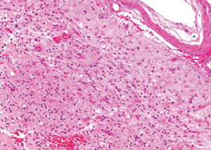 Figure 9: Subacute cortical microinfarct displaying loss of parenchyma and reactive gliosis.