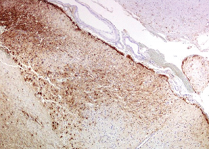 Immunohistochemistry for GFAP (glial fibrillary acidic protein) highlights the reactive gliosis of the subacute infarct.