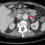 Case Report: Coccidioides Immitis Infects a Patient’s Vascular Graft