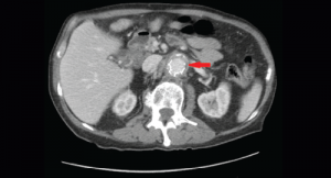 Case Report: Coccidioides Immitis Infects a Patient’s Vascular Graft