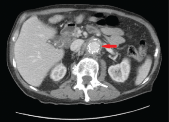 Figures 1A (left) & 1B (right): A CT scan with abdominal and pelvic axial (a) and sagittal (b) views showing inflammatory changes (red arrow) adjacent to the aorta.