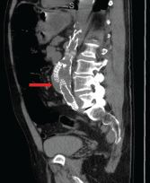 Case Report: Coccidioides Immitis Infects a Patient’s Vascular Graft