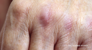 Cancer-Associated Myositis: A Case Report & Review of the Literature