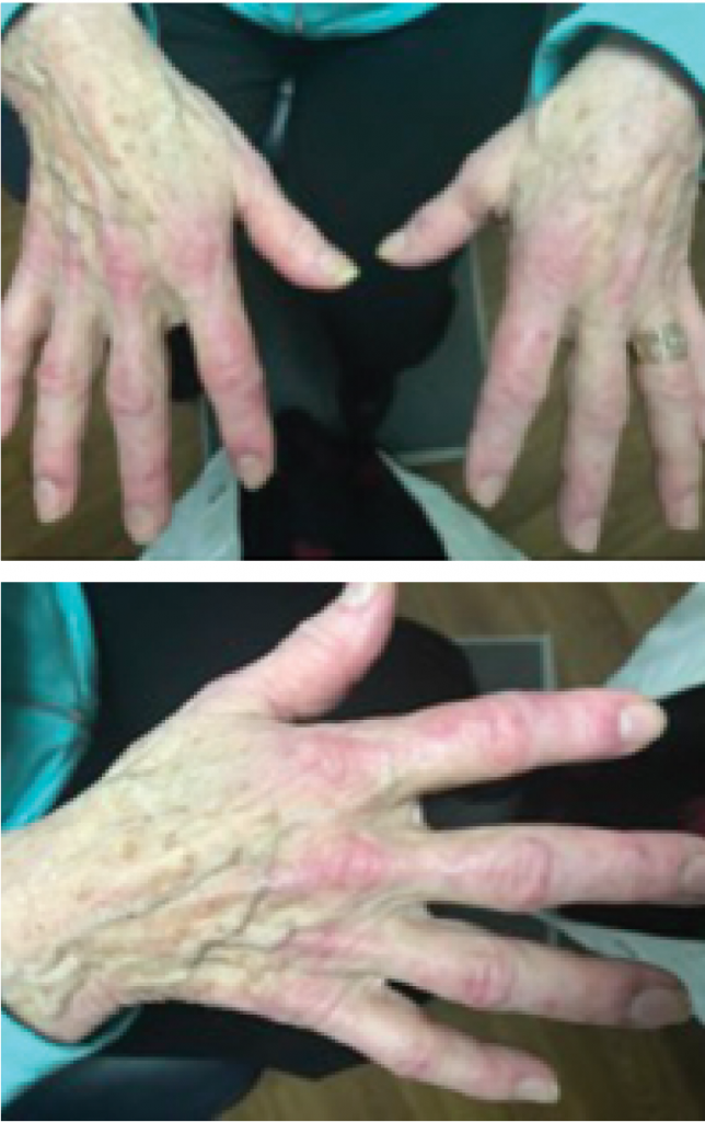 Figures 1 & 2: A hallmark skin manifestation of dermatomyositis includes Gottron’s papules, lesions consisting of erythematous to violaceous papules and plaques found over the metacarpophalangeal and interphalangeal joints.