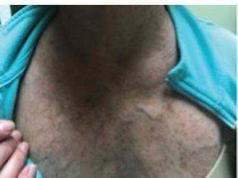 Figure 3: The flushing rash of carcinoid can mimic the rash of dermatomyositis, particularly the V sign, which refers to macular erythema over the anterior neck and upper chest.