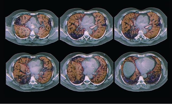 Colored computed tomography (CT) scans of axial sections through the chest of a 68-year-old patient with interstitial lung disease (diffuse parenchymal lung disease, DPLD). Parenchymal disease appears in less than 5% of lupus patients.