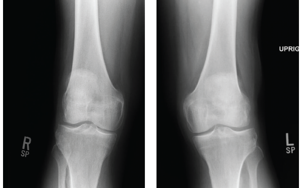 Figures 1 & 2: X-rays of the Right & Left Knees