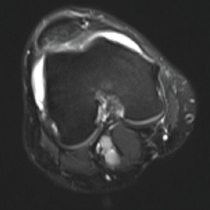 Figure 3: MRI of the Knee