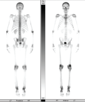 Figure 4: Bone Scan