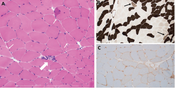 A: HE staining. One necrotic fiber was observed (large arrow). Some muscle fibers with internal nuclei were observed (small arrow). B: ATPase staining. A few type 2C fibers were observed (arrows). C: MHC Class I staining. Moderate upregulation of sarcolemmal MHC class I molecule was seen.