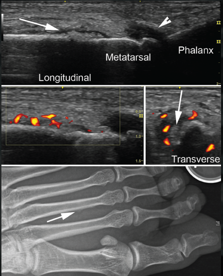 Ultrasound Image Review: A 30-Year-Old Woman with Left Foot Pain