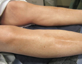 Figure 3. The skin of the patient’s lower extremities was shiny, thickened and hairless.