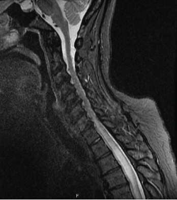 Figure 1: MRI of the spine