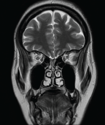 Figure 2: AN ORBITAL MRI