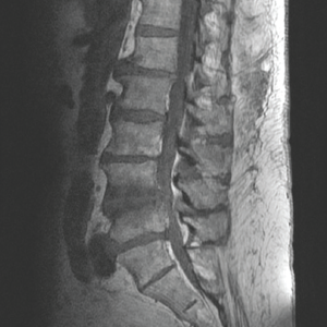 This MRI of the spine shows inflammatory involvement of the L4 and L5 disc space.