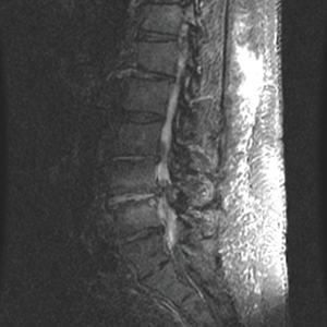 Periarticular end plate edema is apparent at the L4–L5 facet joints.