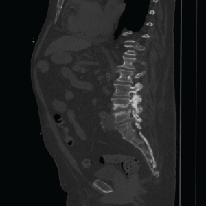 Advanced multi-level degenerative changes, as well as end plate sclerosis and erosions, are shown. They are the worst at the L4–L5 intervertebral disc space.