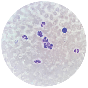 Lupus erythematosus cells on 100X light microscope stain.