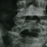 A New Treatment for Axial Spondyloarthritis?