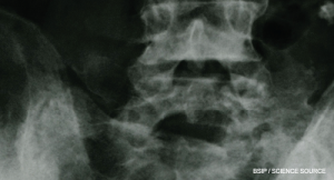 A New Treatment for Axial Spondyloarthritis?