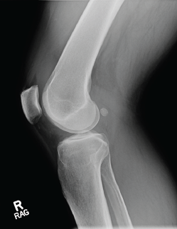 Photo 1: An X-ray of the right knee reveals a moderate-sized effusion.