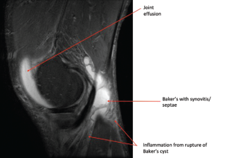 Photo 2: This MRI of the right knee shows a large joint effusion and a ruptured Baker’s cyst with synovitis.