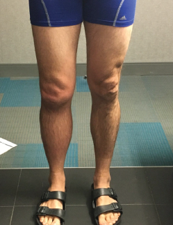 Photo 3: The patient has obvious swelling in the right knee.