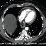 This CT scan demonstrates a mass causing partial occlusion of the esophagus.