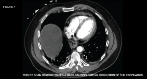 This CT scan demonstrates a mass causing partial occlusion of the esophagus.