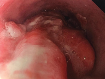 Endoscopy findings reveal distal esophageal adenocarcinoma.