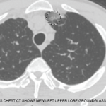 This chest CT shows new left upper lobe groundglass opacity.