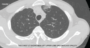 This chest CT shows new left upper lobe groundglass opacity.