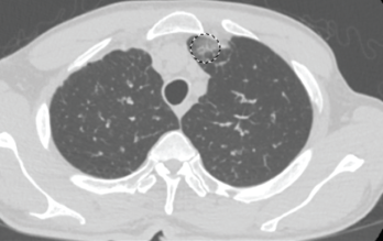 This chest CT shows new left upper lobe groundglass opacity. 